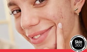 Stubborn AM Acne Treatment With Benzoyl Peroxide